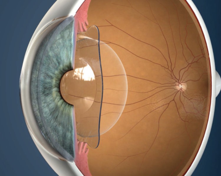 Stier Kaarsen min Lens implants ICL - Βλέμμα