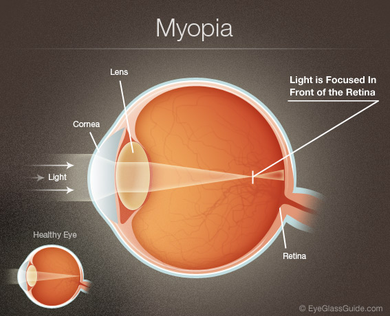 Lézeres Myopia 🚑 borsodjobs.hu